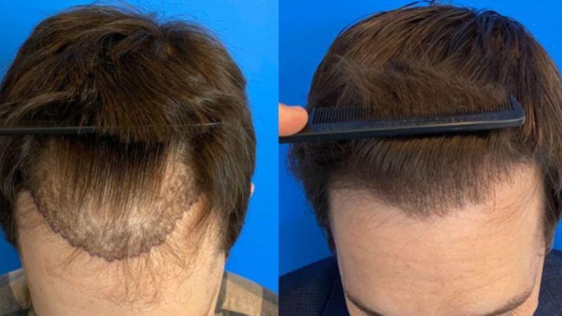 Getting A Dense Hairline With Hair Transplants