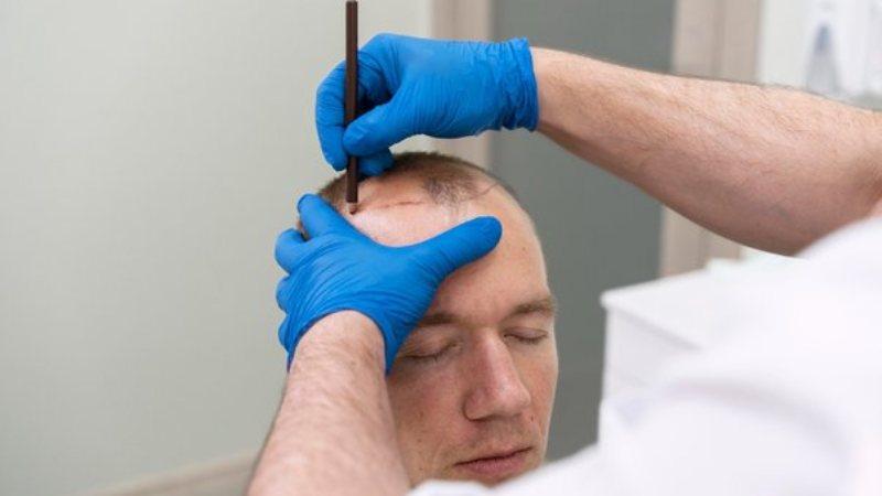 Getting An Affordable Permanent Hair Transplant